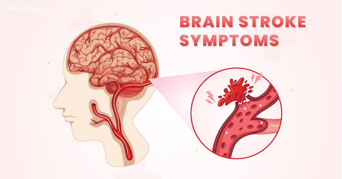 Brain stroke symptoms